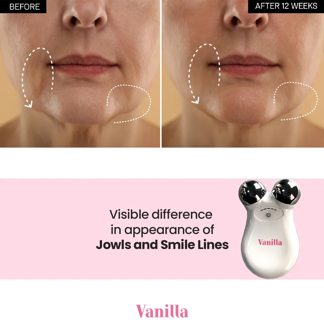 Vanilla jowls and smile lines