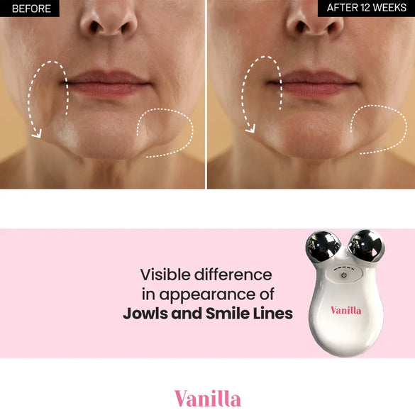 Vanilla jowls and smile lines