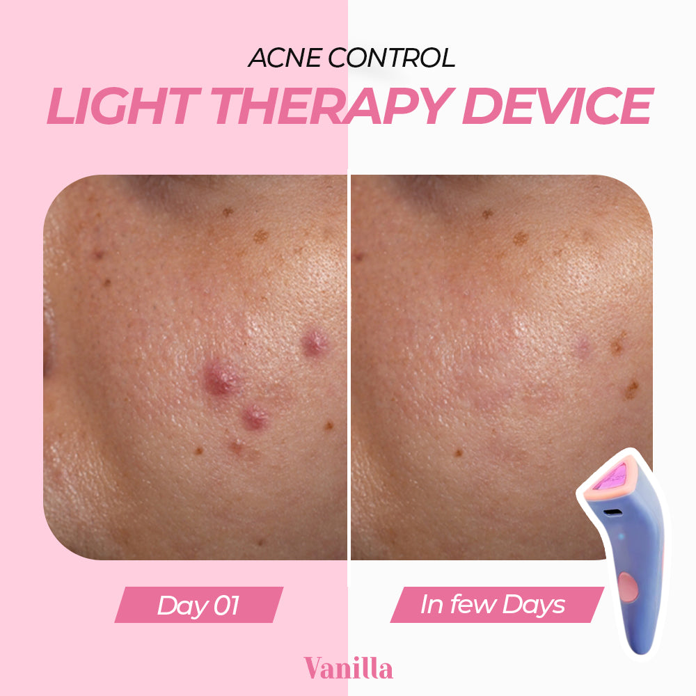 Acne Control Light therapy device