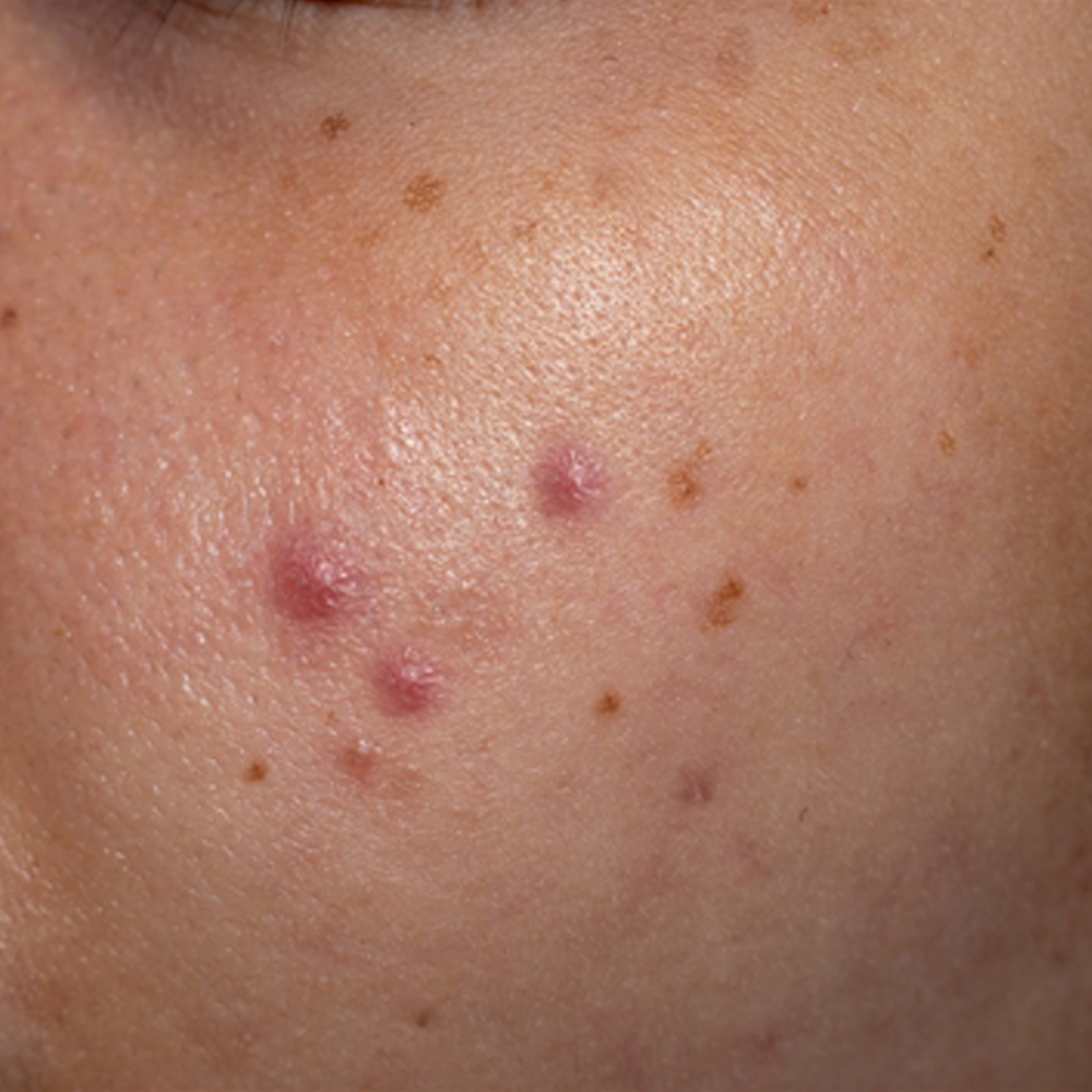 Before treatment