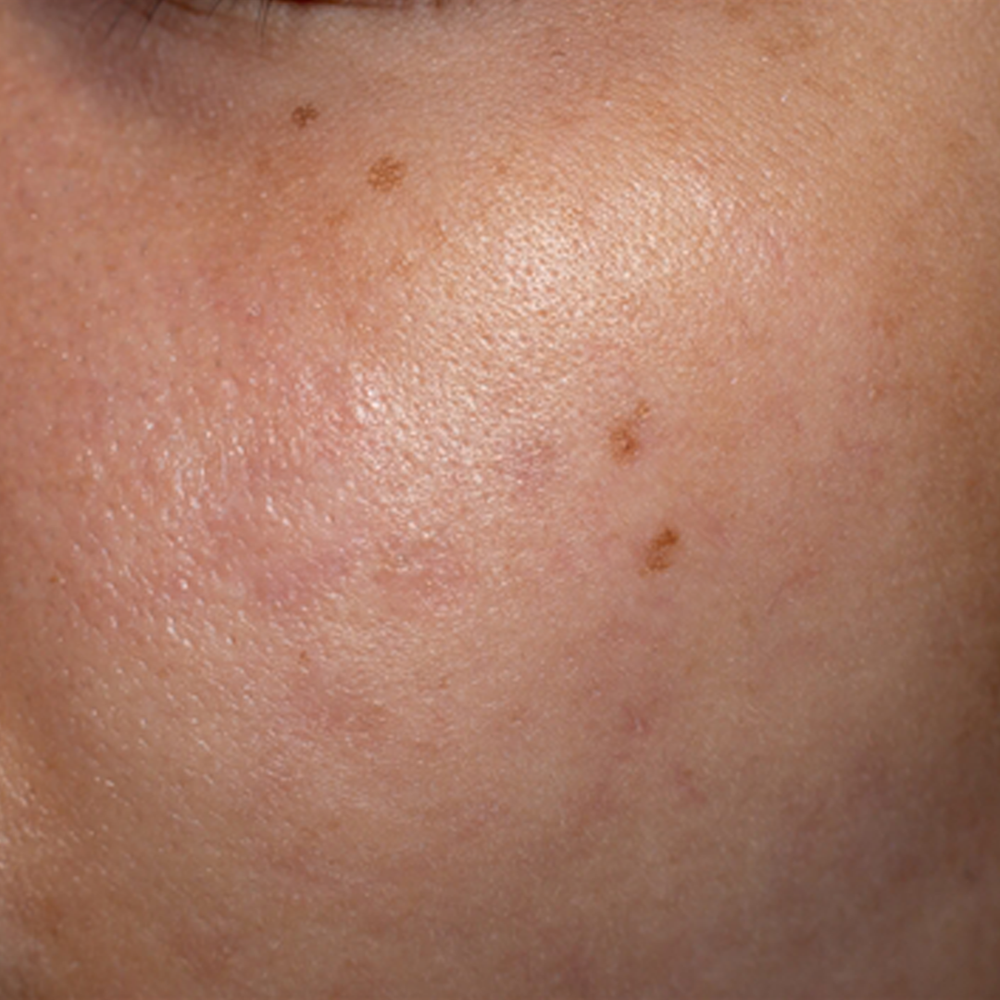 After treatment