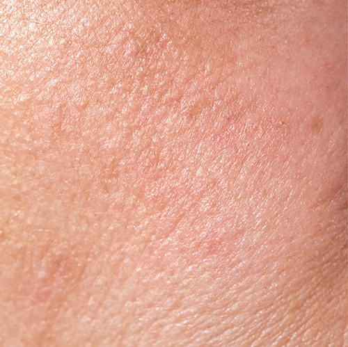 Before treatment