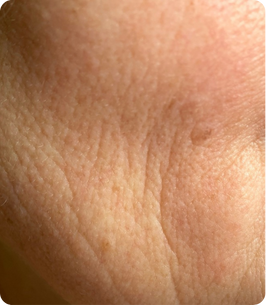 Loose Skin