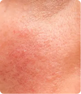 OPEN PORES