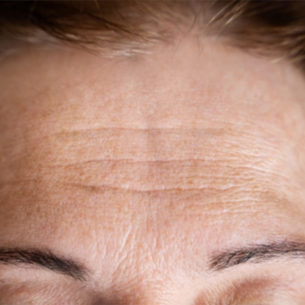 Before treatment