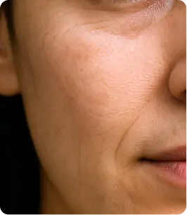 FINE LINES & WRINKLE