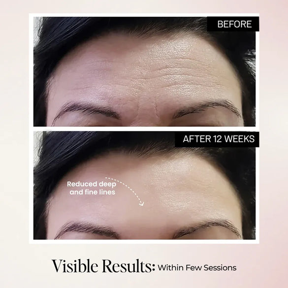 Micro-Current Face Sculpting Device