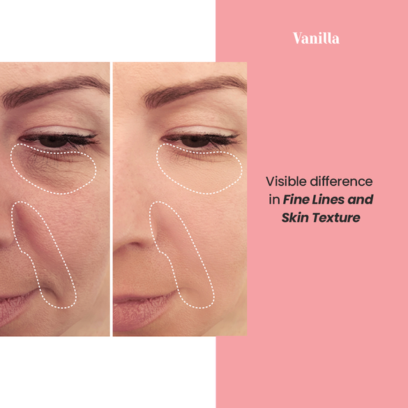 EMS Lifting Device + Activating Gel