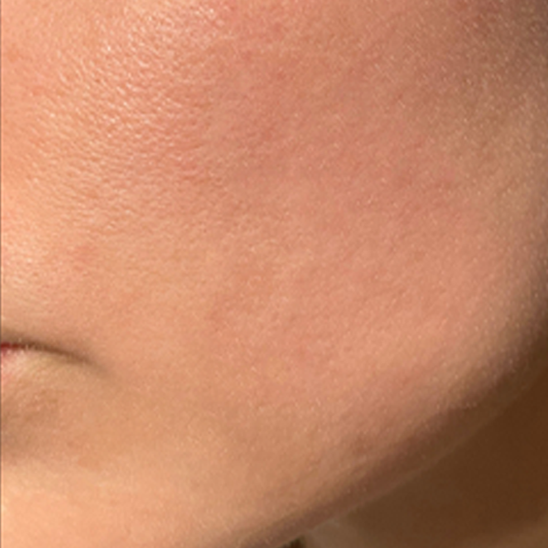 After treatment