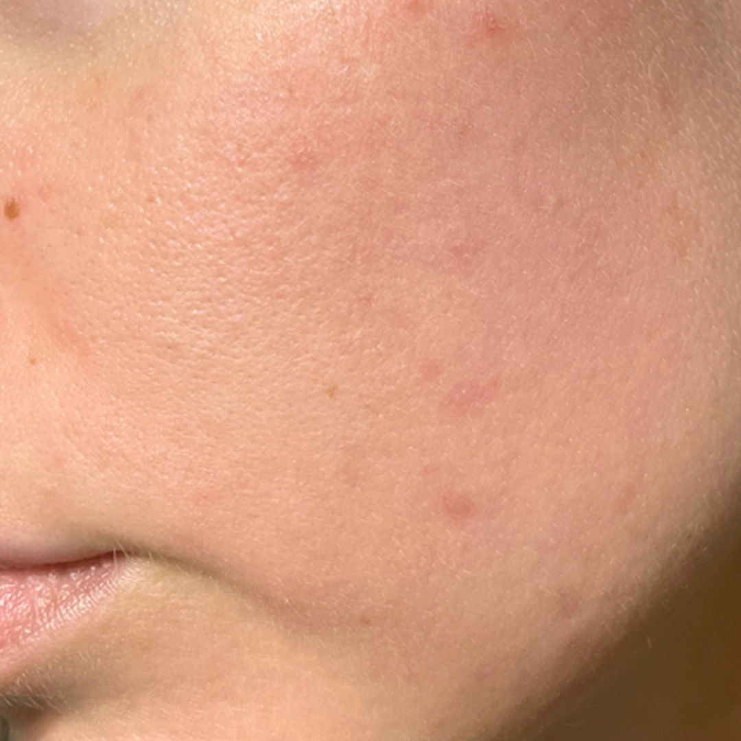 After treatment