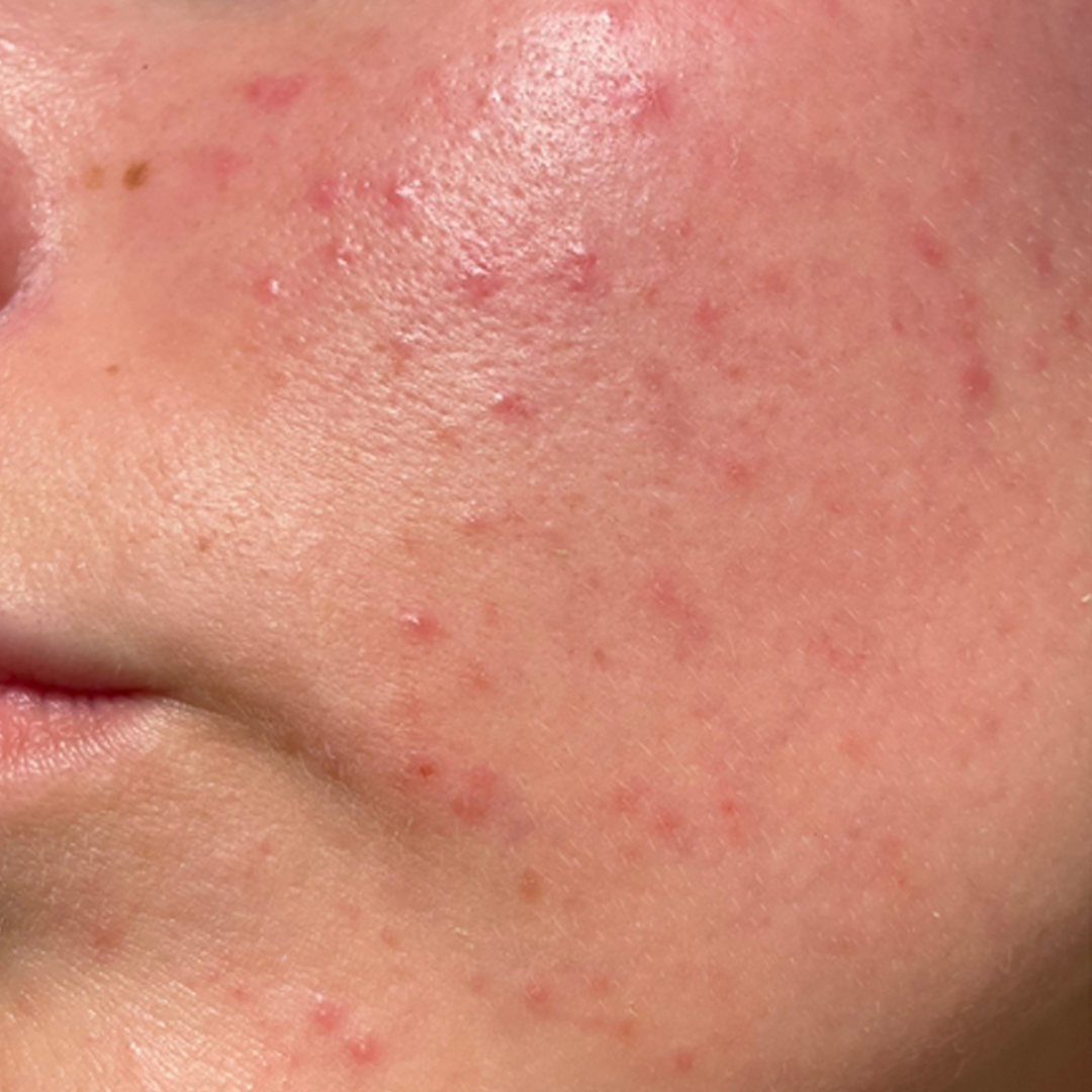 Before treatment